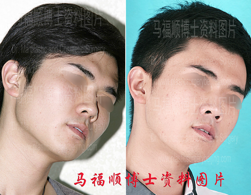 he mandible line changes after mandible reduction surgery the mandible line changes after mandible reduction surgery