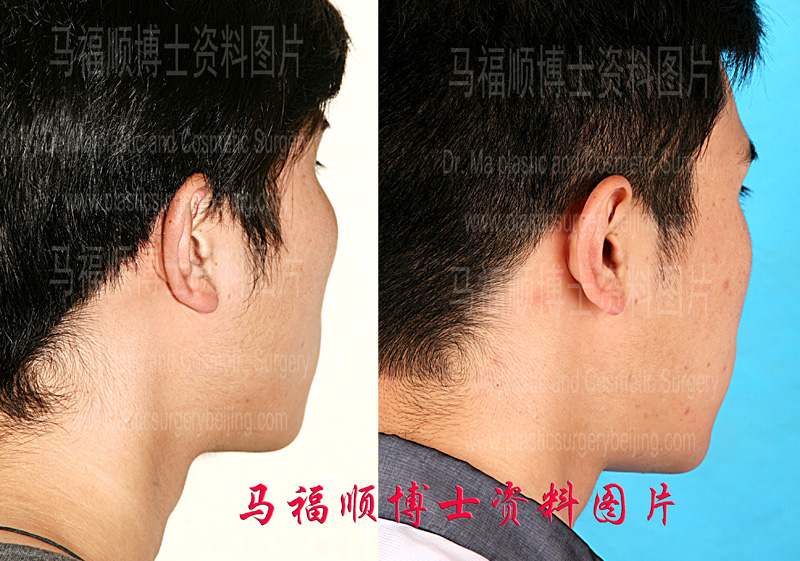 before and after photos of zygoma and mandible reduction surgery in a back front viewing before and after photos of zygoma and mandible reduction surgery in a back front viewing
