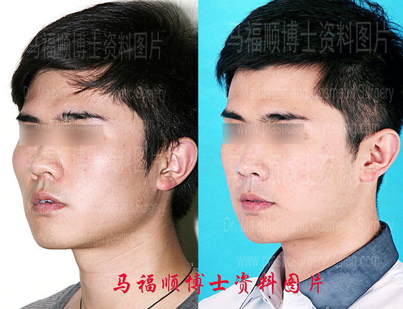 comparison photos after zygoma and mandible reduction surgery comparison photos after zygoma and mandible reduction surgery