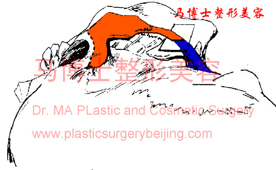Rear end osteotomy zygomatic bone and zygomatic arch plastic surgery