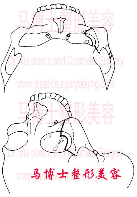 Tripod osteotomy zygomatic bone and zygomatic arch reduction surgery