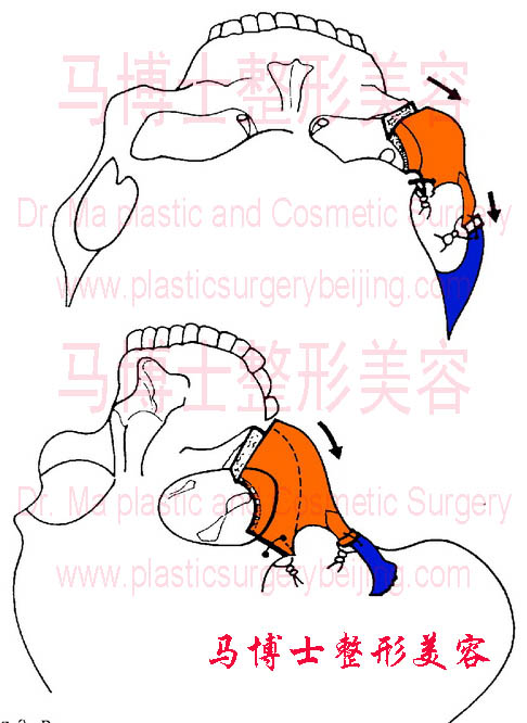 Tripod osteotomy zygomatic bone and zygomatic arch reduction surgery
