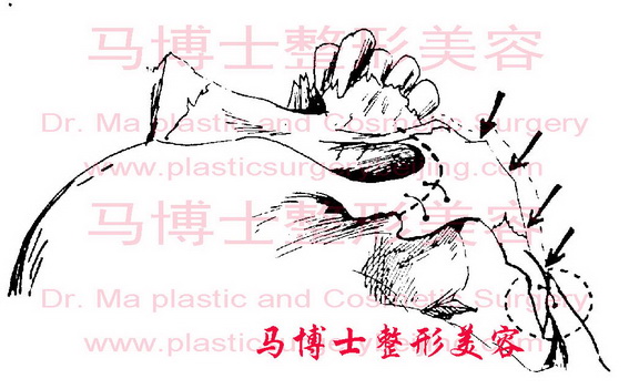 Fixation after Rear End Ostotomy Zygomaitc arch reduction plastic surgery