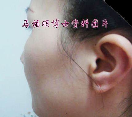 picture of high zygomatic arch