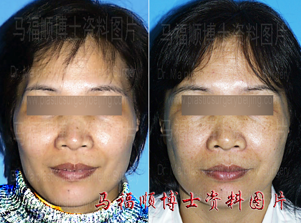 two years after zygoma and zygomatic arch reduction surgery two years after zygoma and zygomatic arch reduction surgery
