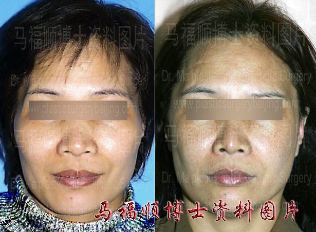 five years after zygoma and zygomatic arch reduction surgery five years after zygoma and zygomatic arch reduction surgery