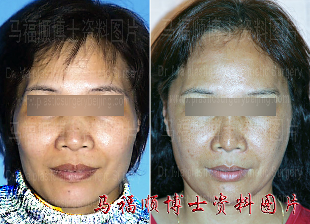 seven years after zygoma and zygomatic arch reduction surgery seven years after zygoma and zygomatic arch reduction surgery