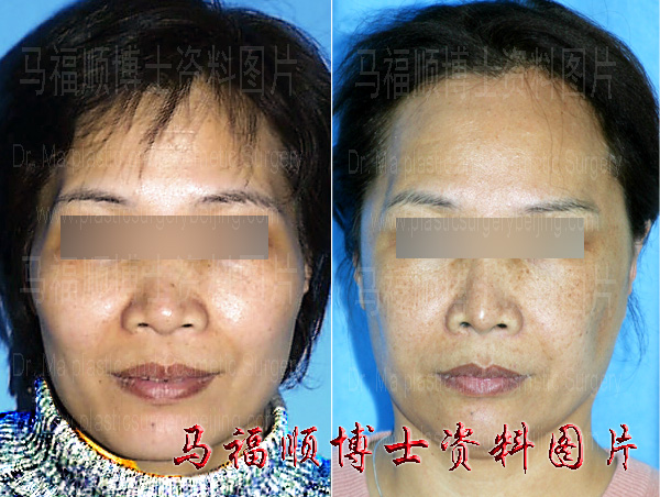 ten years after zygoma and zygomatic arch reduction surgery ten years after zygoma and zygomatic arch reduction surgery