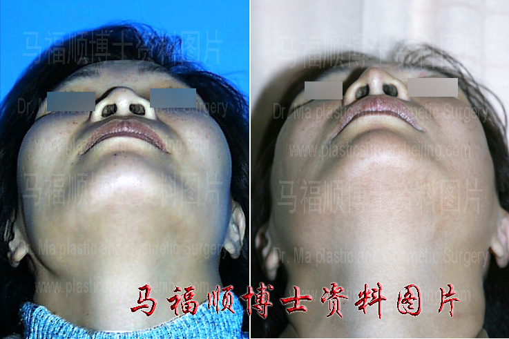 comparison of the zygoma and zygomatic arch area at chin up position between pictures of before and 10 years after operation comparison of the zygoma and zygomatic arch area at chin up position between pictures of before and 10 years after operation