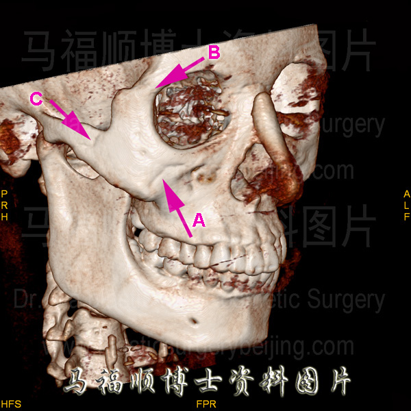 3D CT image of the facial bone 3D CT image of the facial bone