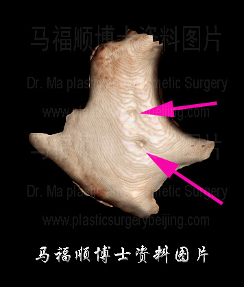 CT image of the zygomatic bone CT image of the zygomatic bone
