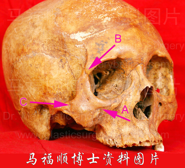 the zygomatic bone and its neibough the zygomatic bone and its neibough