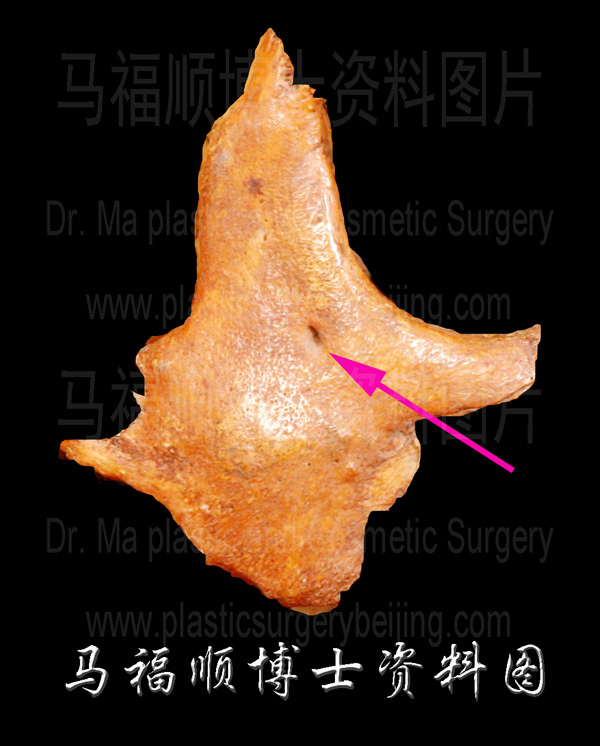 photo of zygomatic bone photo of zygomatic bone