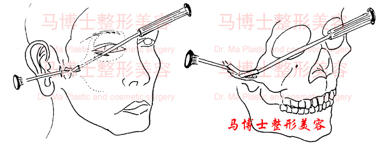 simple zygomatic bone and zygomatic arch reduction
