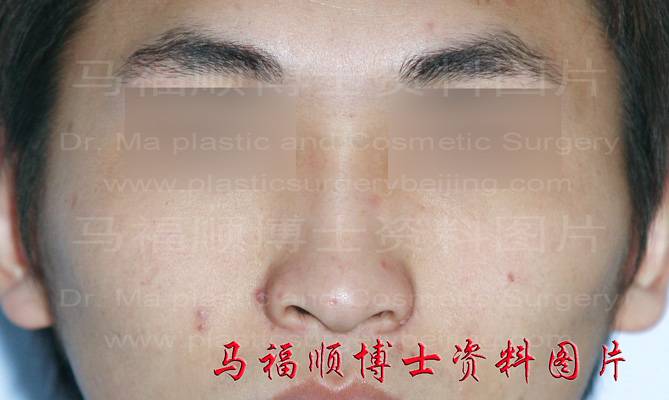 male pattern high zygoma and zygomatic arch