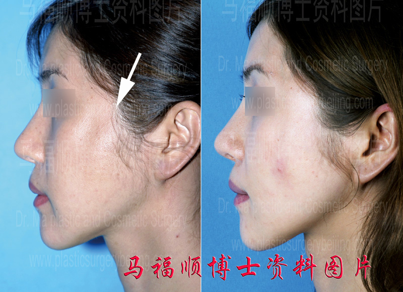 zygomatic arch and zygomatic bone revision surgery in profile view