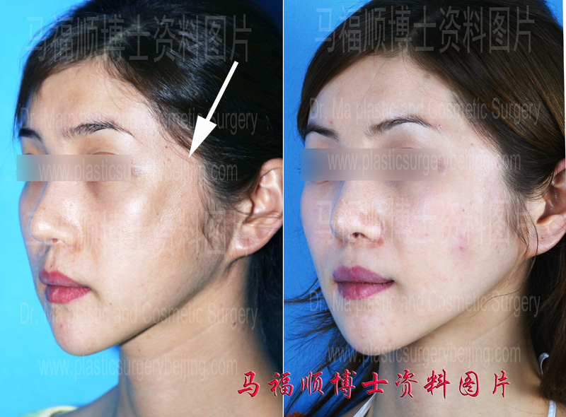 revision surgery for post surgical zygomatic arch and zygomatic bone displacement