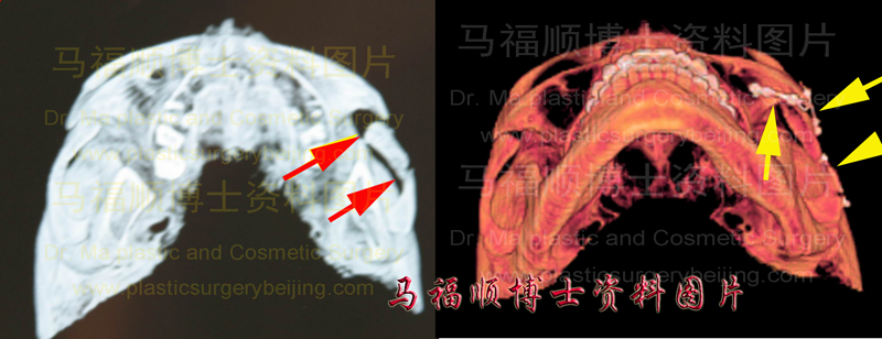 restoration of post surgical displaced zygomatic arch and zygomatic bone