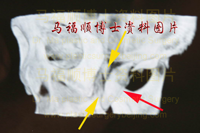 downward displaced zygomatic bone and zygomatic arch