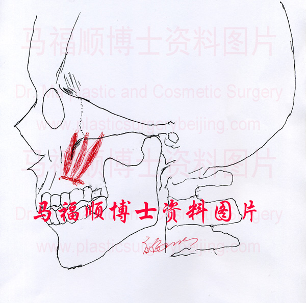 zygoma bone zygomatic arch and expression muscles zygoma bone zygomatic arch and expression muscles