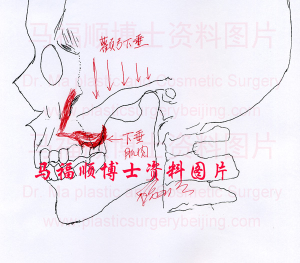 zygomatic bone and zygomatic arch sagging zygomatic bone and zygomatic arch sagging