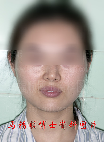 no sagging after face reduction no sagging after face reduction