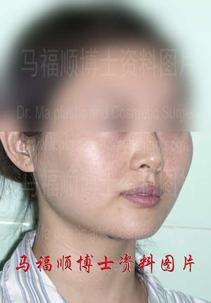 no facial sagging after facial bone reduction no facial sagging after facial bone reduction