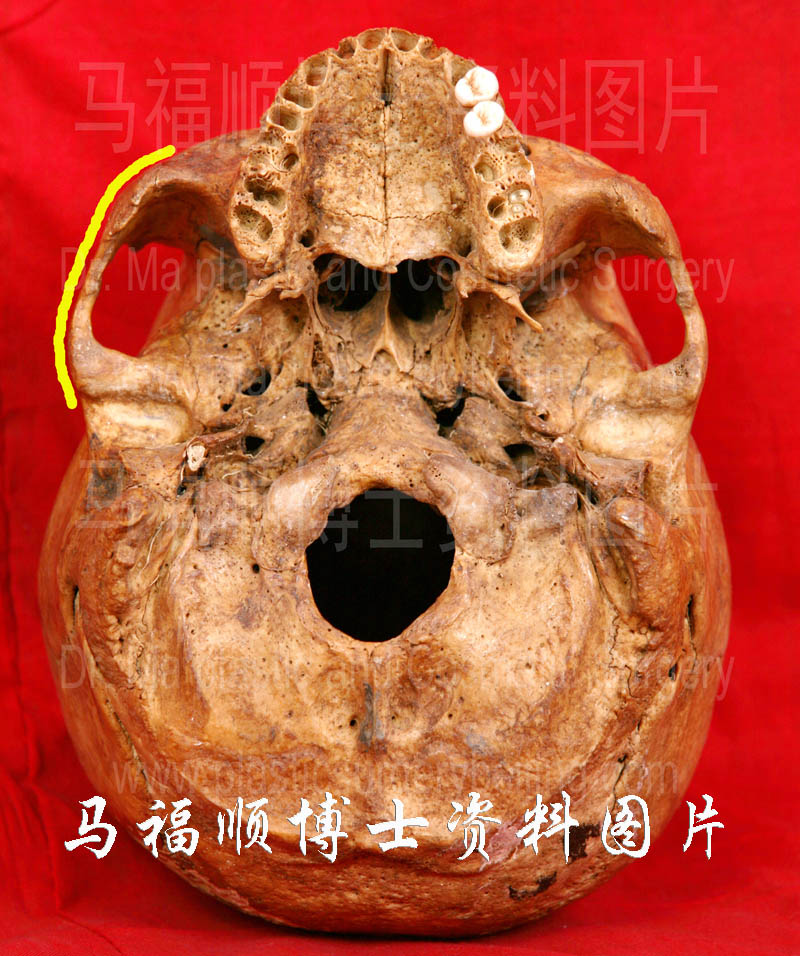 photo of the zygomatic arch