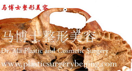 The Front end osteotomy zygoma plastic surgery