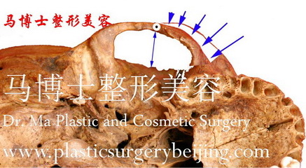 The Front end osteotomy zygoma plastic surgery