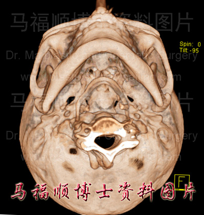CT image of narrow zygomatic arch
