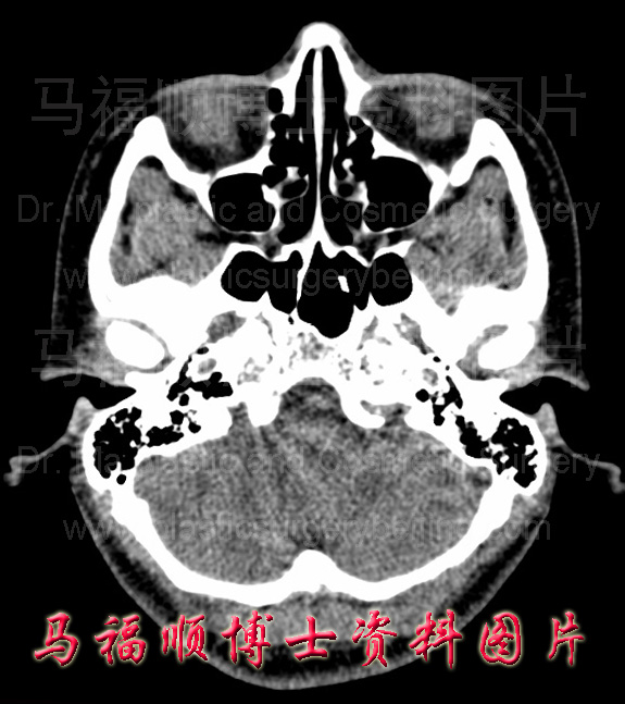 CT image of narrow zygomatic arch