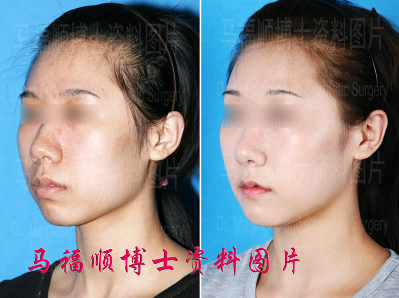 minor mouth protrusion plastic surgery before and after photos