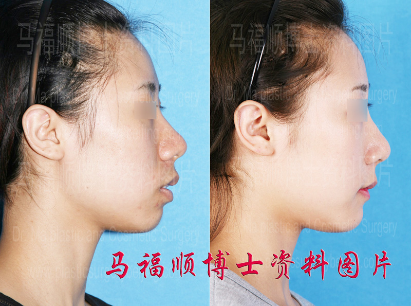 mouth protrusion surgery in profile