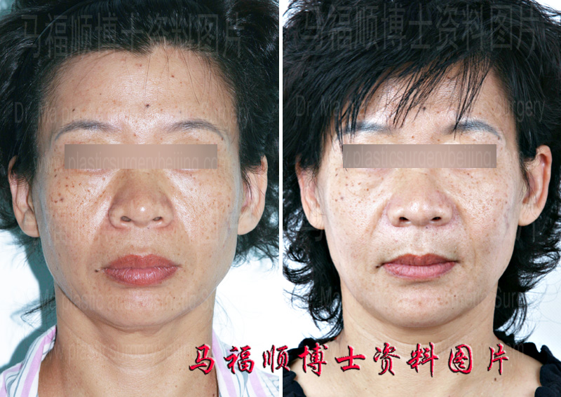 maxillary protrusion correction