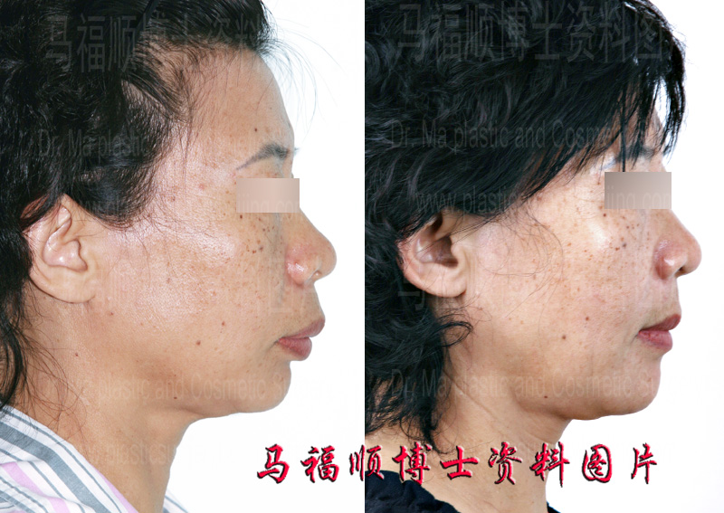 maxillary protrusion in profile