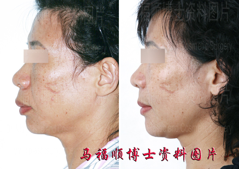 maxillary protrusion correcton in profile