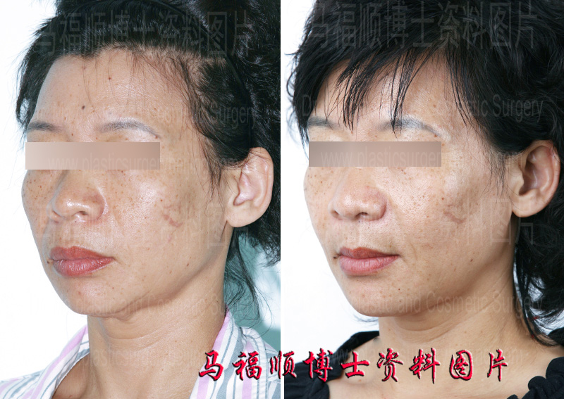 maxillary protrusion correction before and after surgery photos