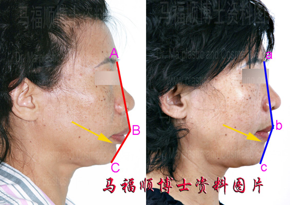maxillary protrusion analysis