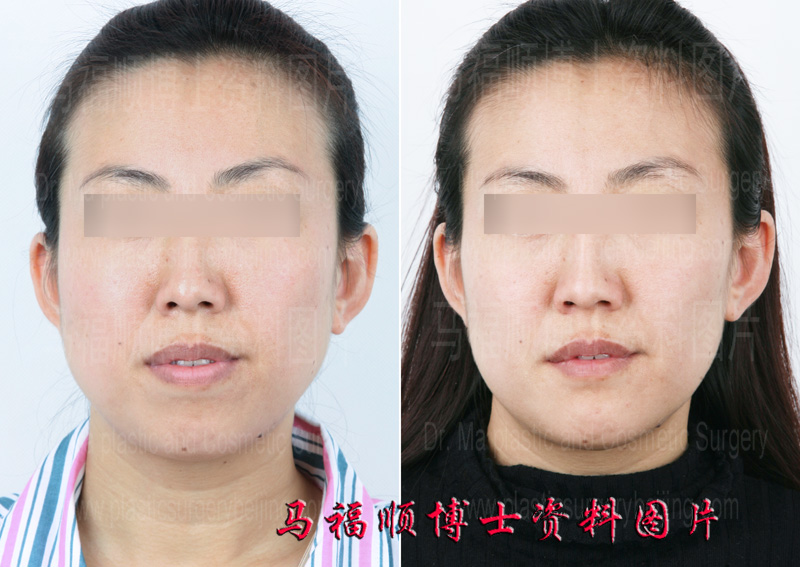 protrusion mouth platic surgery