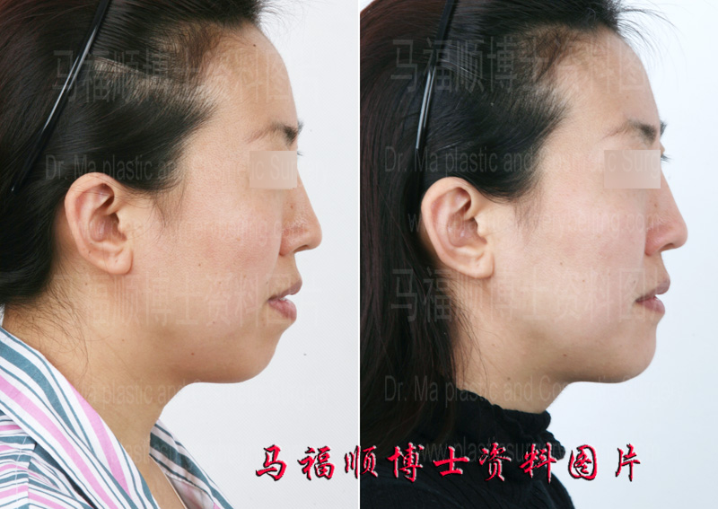 upper and lower jaw protrusion surgery