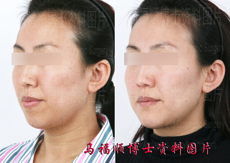 mouth protrusion surgery