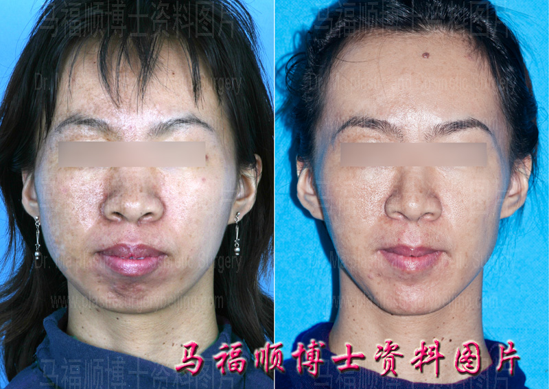 before and after photos of bimaxillary protrustion correction