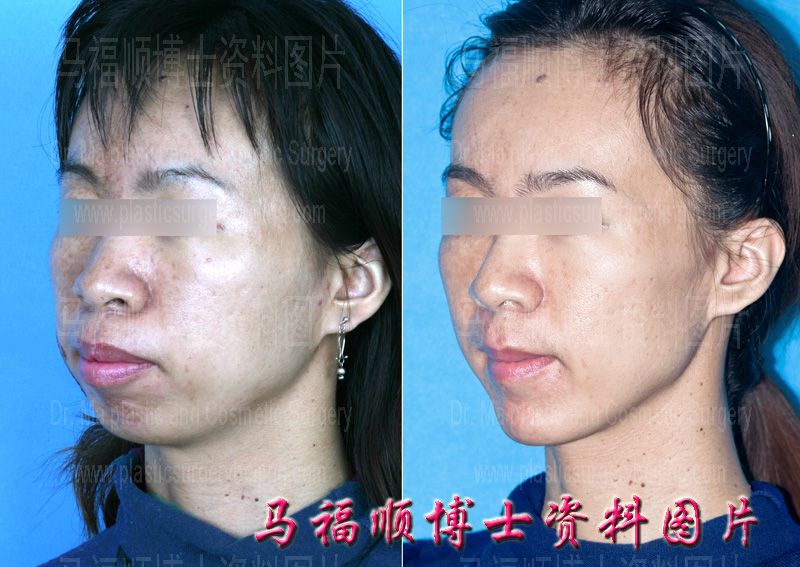 angled view of bimaxillary protrusion correction photos