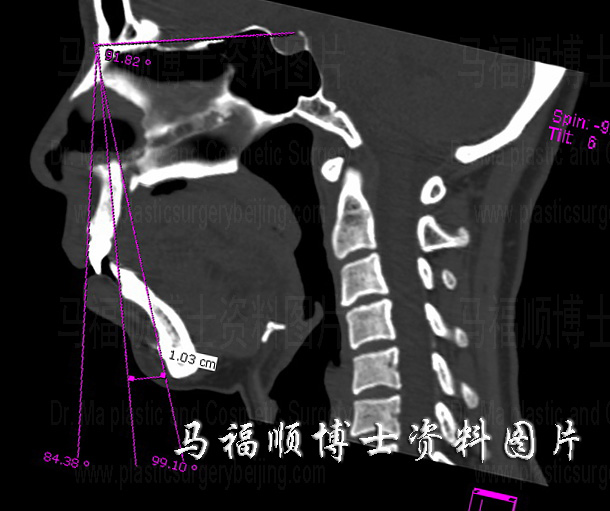 bimaxillary protrusion CT image