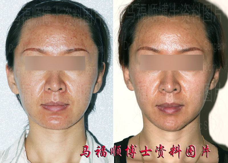 chin forward sliding and reduction surgery