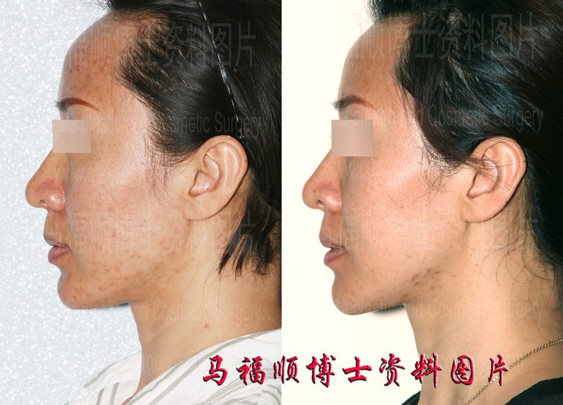 before and after photos of chin forward sliding surgery