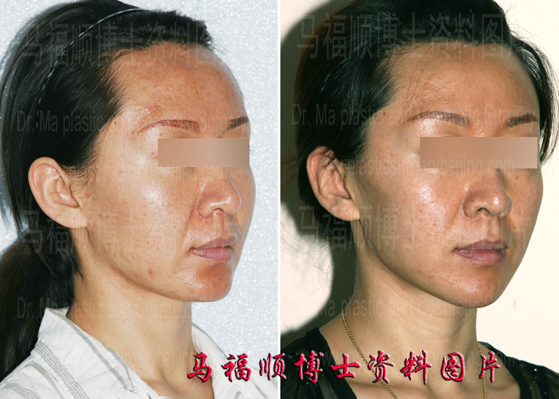 chin narrow reduction surgery