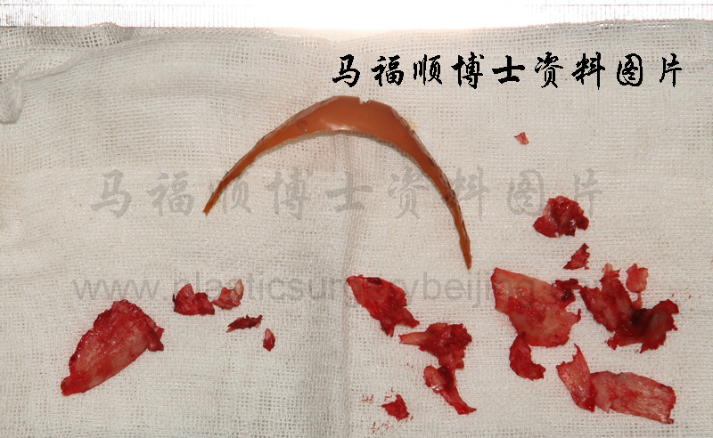 the removed implant and bone pieces during surtgery