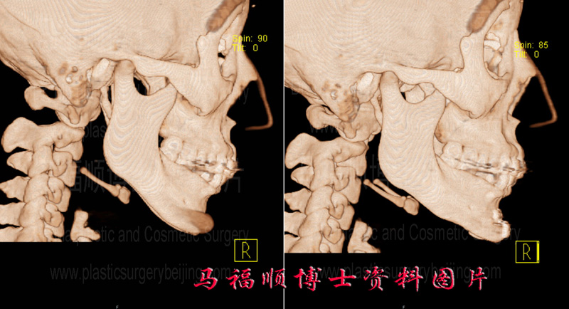 CT image of chin implant and chin forward sliding surgery